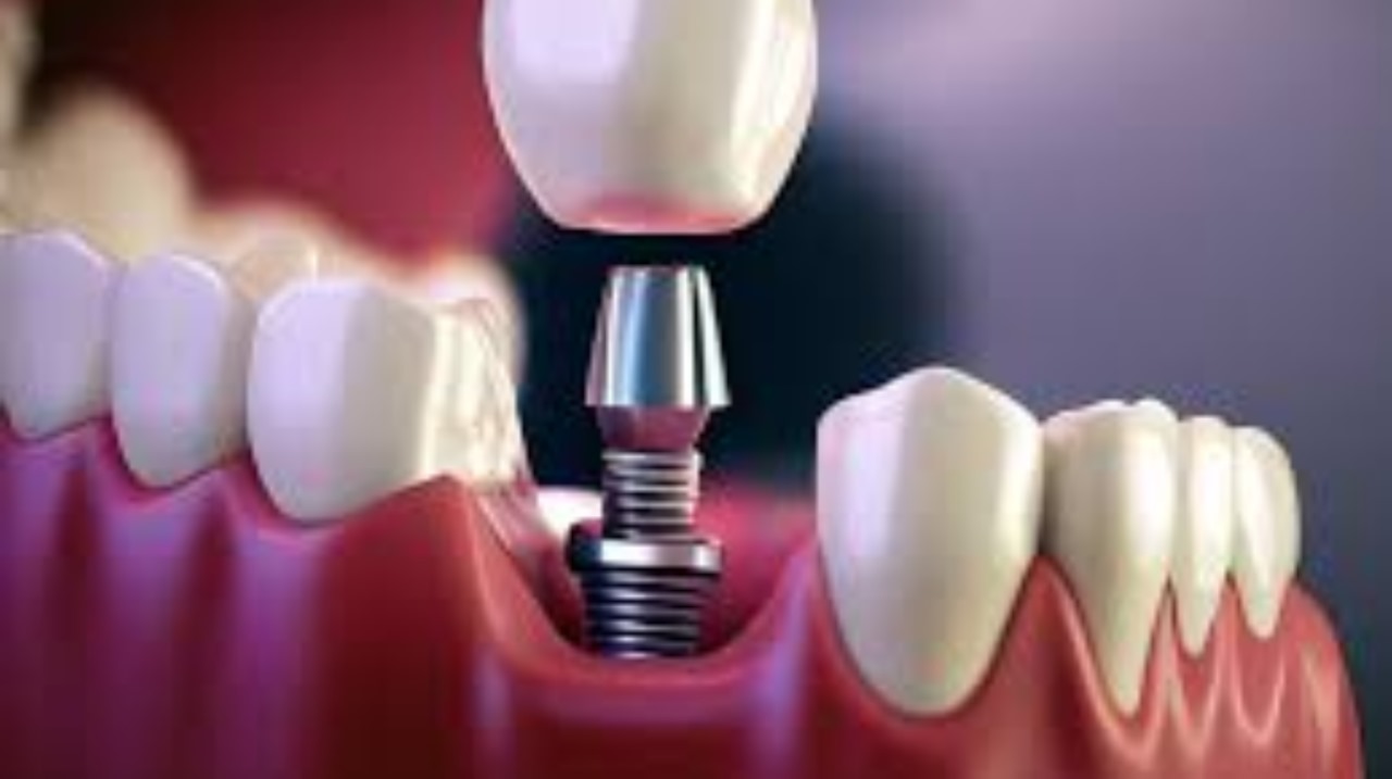 Dental Implants